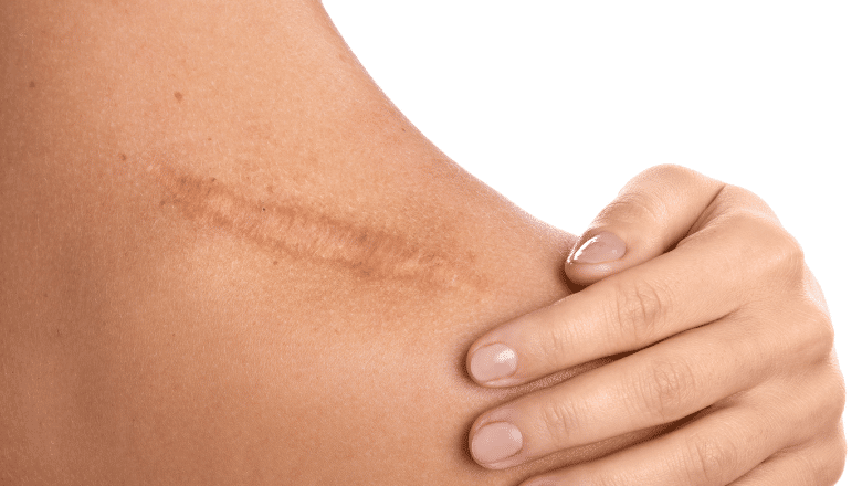 Different types of scars and treatment options at Centre for Surgery London