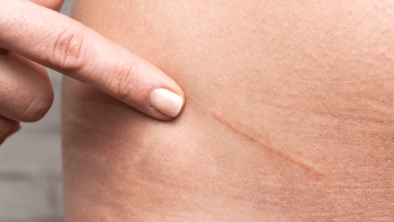 Reducing appendix scars at Centre for Surgery London