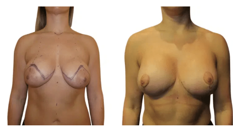 Breast-Uplift-Before-and-After-UK