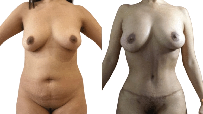 mummy makeover tummy tuck and breast lift before after (1)