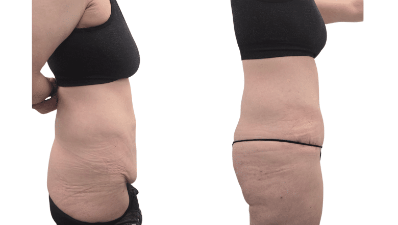 belly overhang tummy tuck results