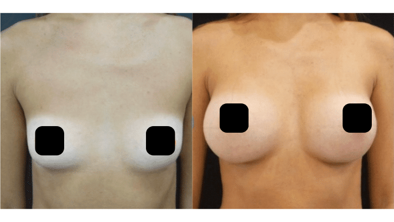 breast implants 300cc before and after London
