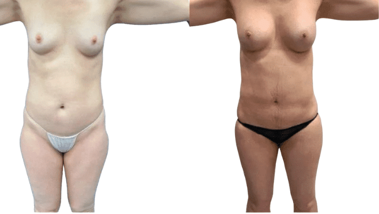 breast implants 500cc before and after