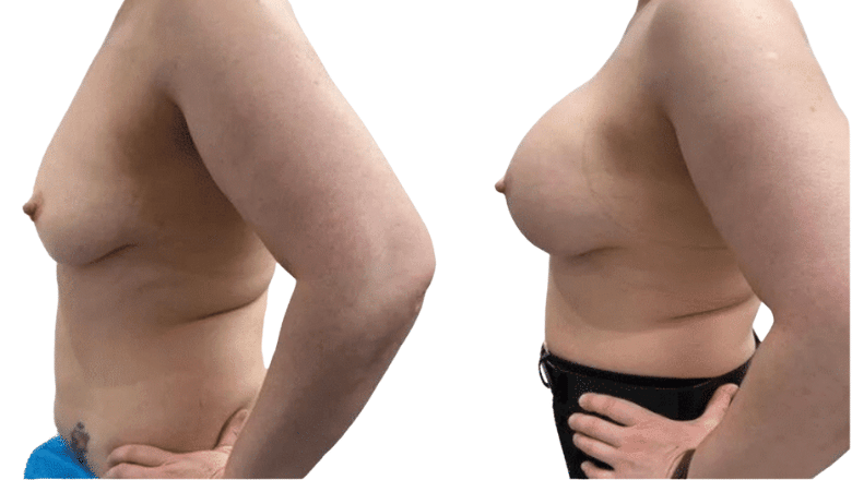breast augmentation before and after case 21