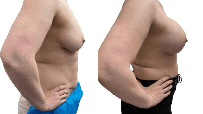 breast augmentation natural results London