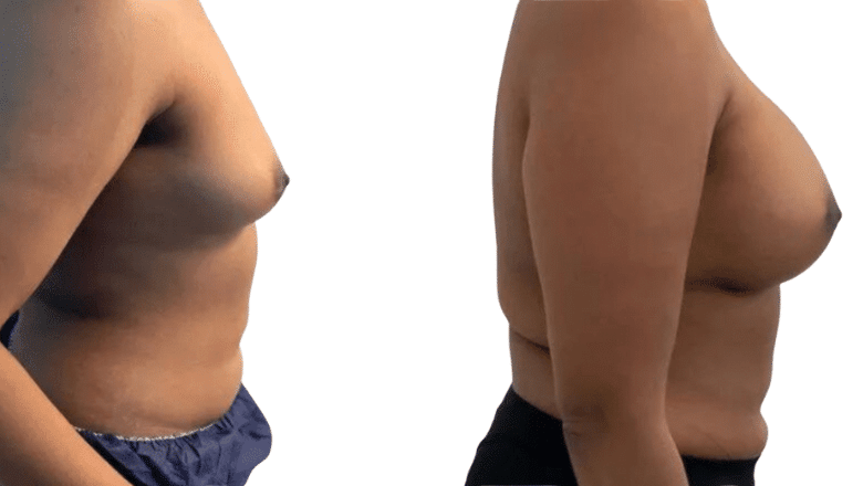 breast implants 250cc before and after