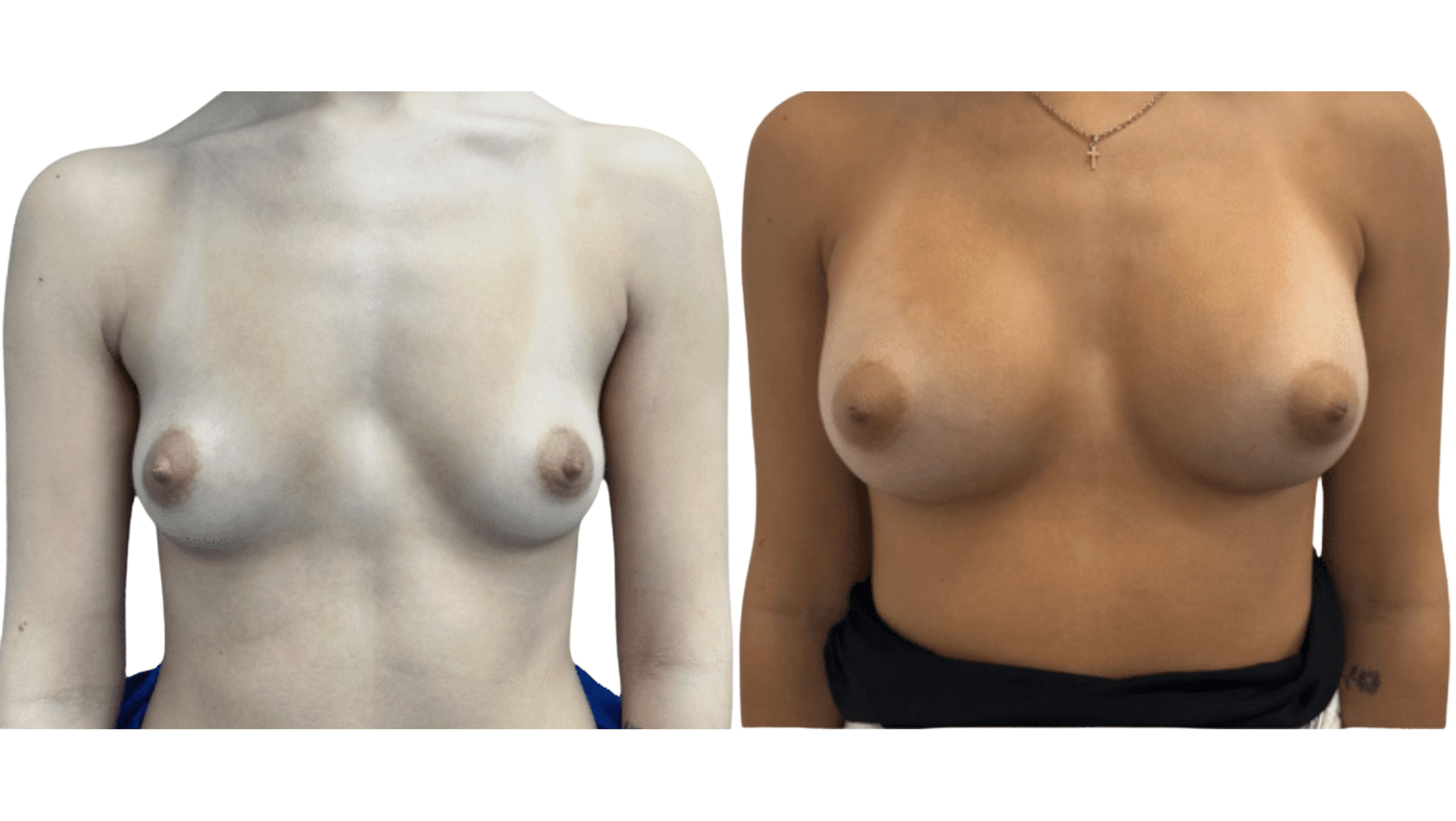 breast augmentation before and after case 17 view 5