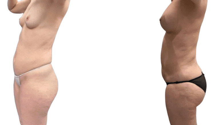 breast augmentation results before and after