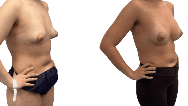 breast augmentation side view before and after