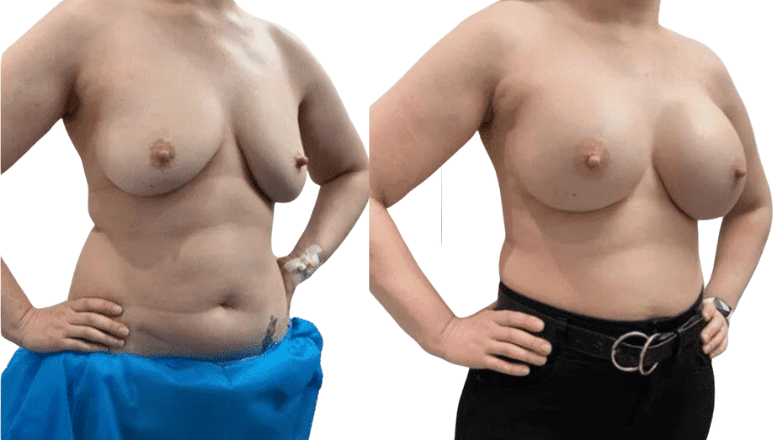 breast augmentation surgery before and after London