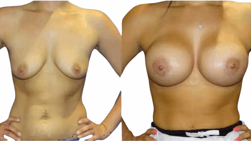 breast augmentation before and after case 17 view 2
