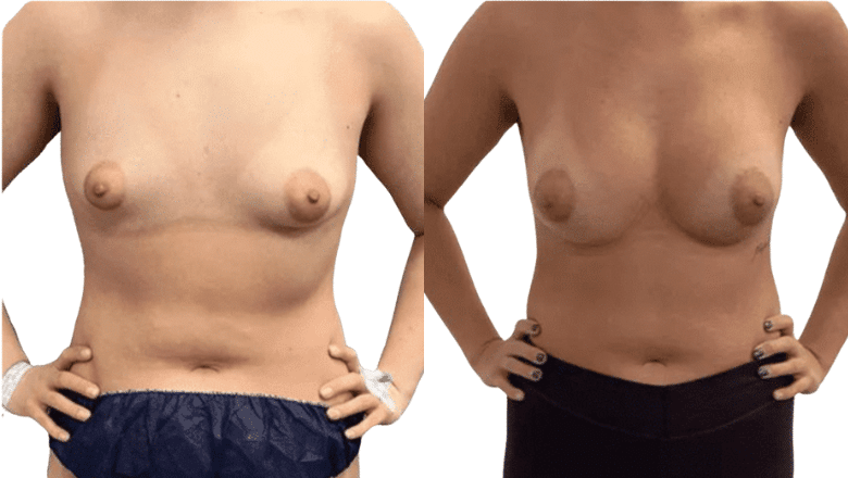 breast augmentation before and after case 27