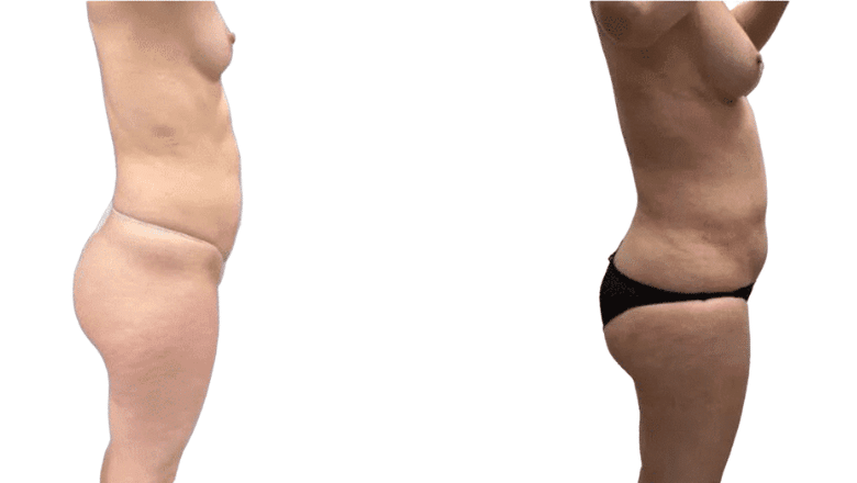 breast enlargement results London