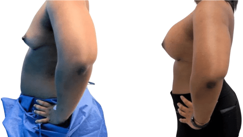 breast enlargement side view before and after