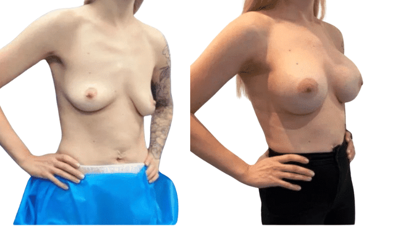 breast enlargement before and after London