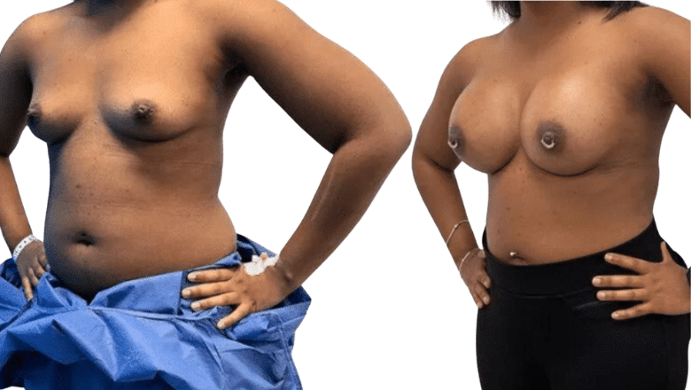 breast implant enlargement surgery UK before and after