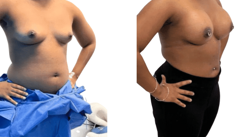 breast implant enlargement UK results