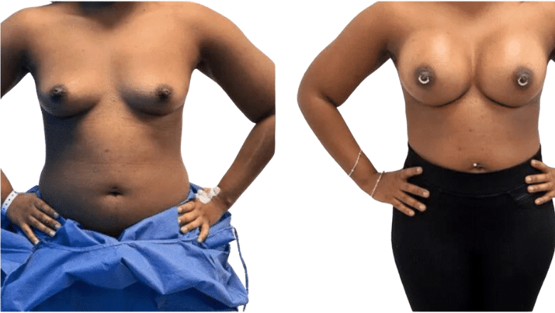 breast implant enlargement before and after