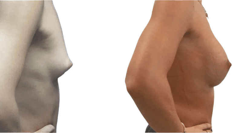 breast augmentation before and after case 10