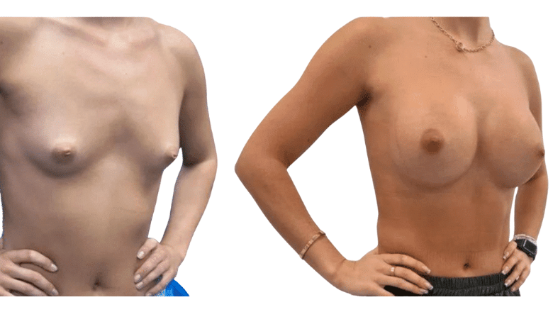 breast augmentation before and after case 9