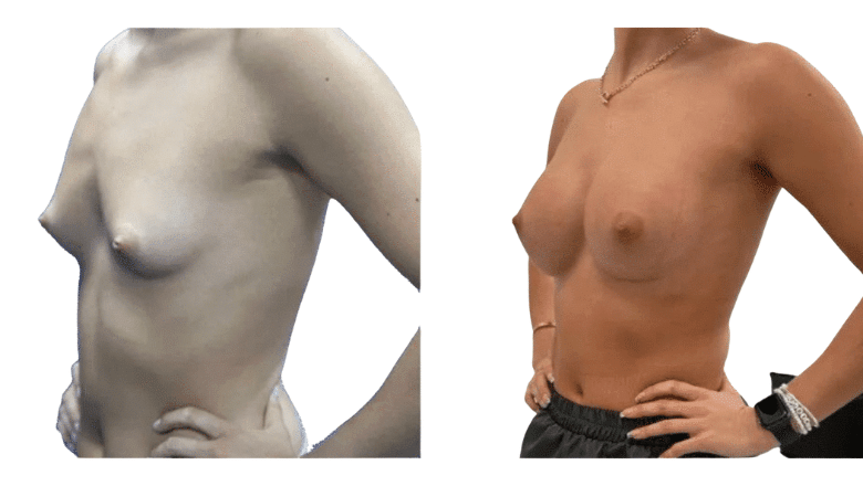 breast augmentation surgery before and after UK