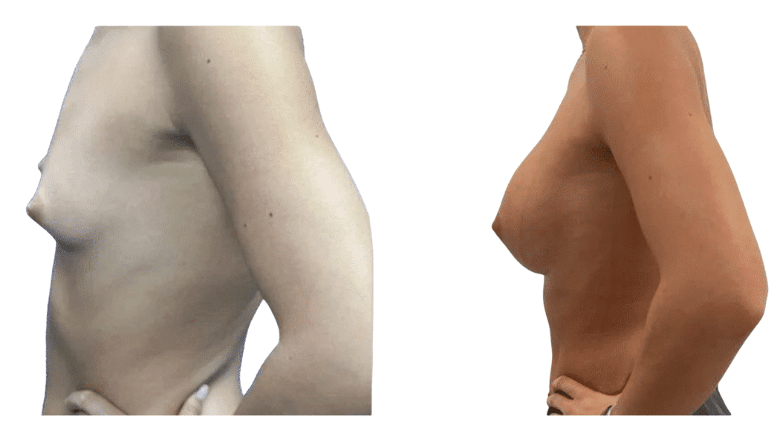 breast implant results London