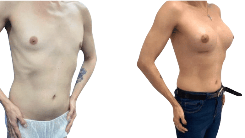 breast enlargement before and after UK
