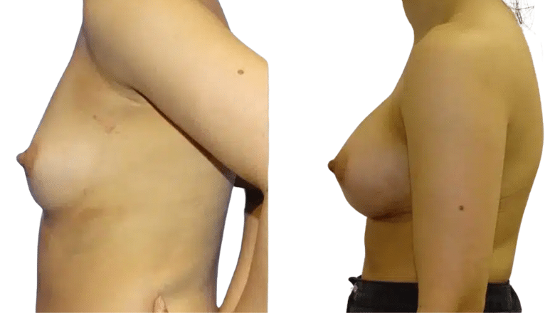 breast augmentation before and after case 17
