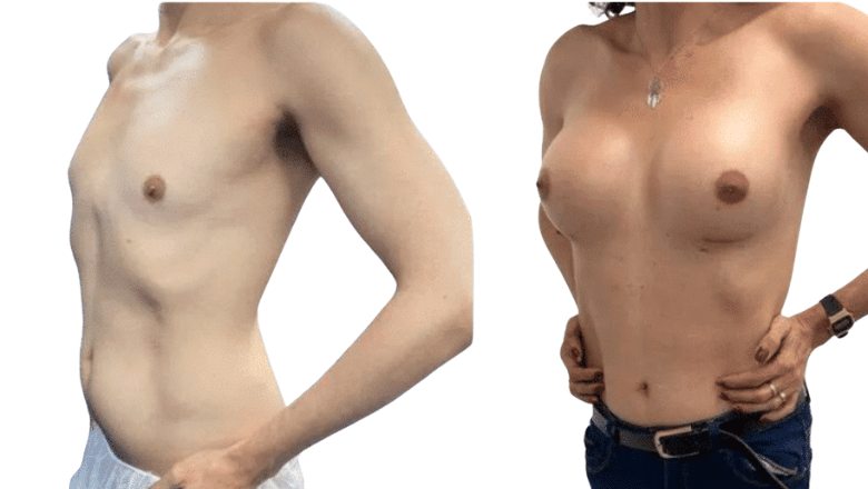 breast implant before and after London