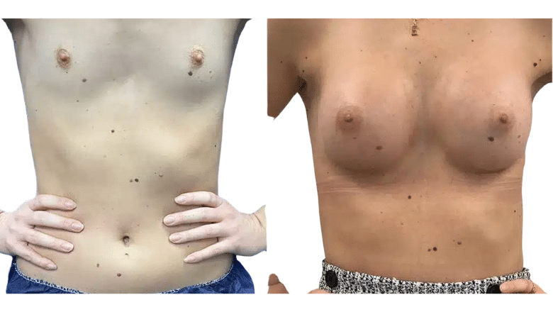 breast augmentation results UK