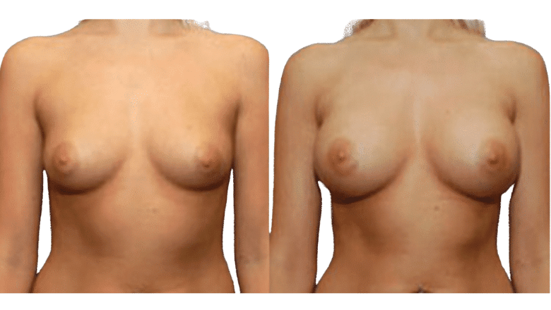 breast augmentation before and after case 16 view 3