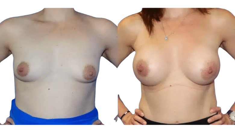 breast augmentation before and after case 16