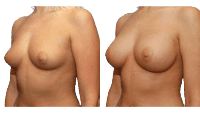 breast augmentation before and after case 15 view 2