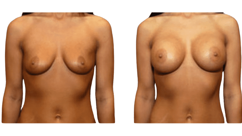 breast augmentation before and after case 15