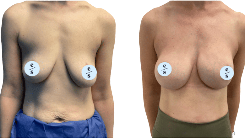 breast implant before and after case 14