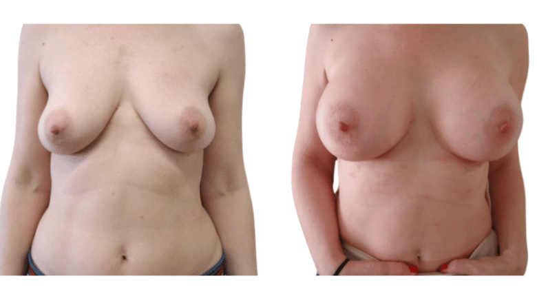 breast enlargement results UK