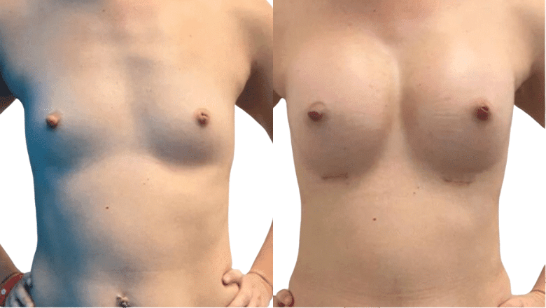 breast implant surgery results London