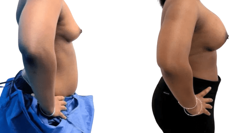 breast implant side view before and after
