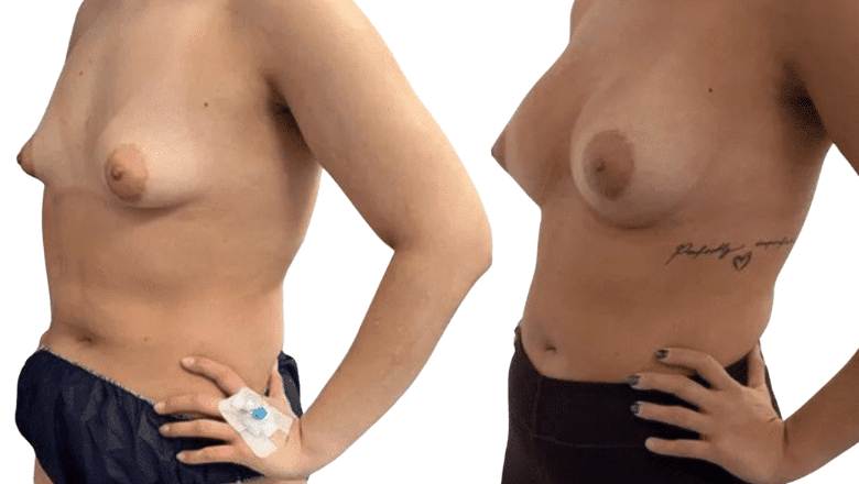 breast implants 320cc before and after