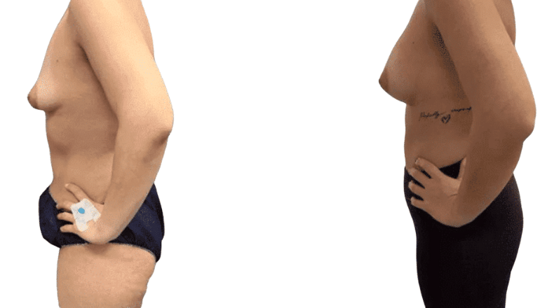 breast implants 350cc before and after London