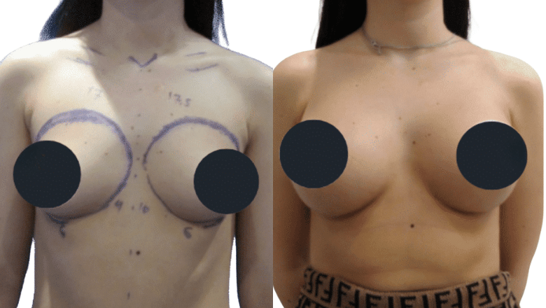 breast implants 360cc before and after London