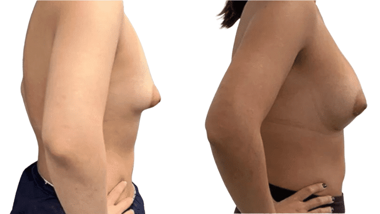 breast implants 400cc before and after London