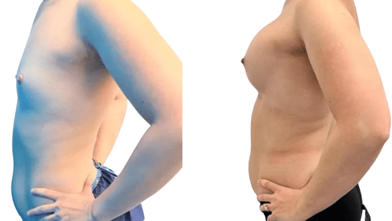 breast implants surgery before and after