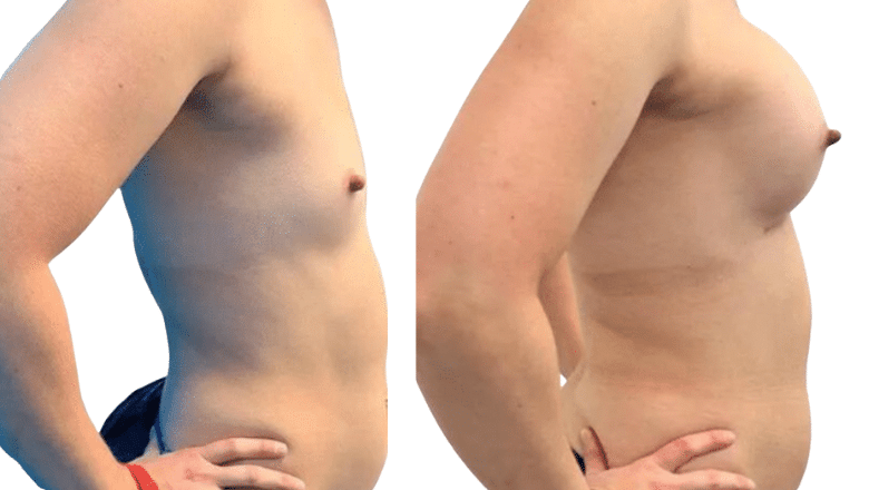 breast implants UK before and after