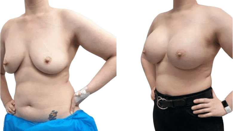 breast augmentation procedure results London