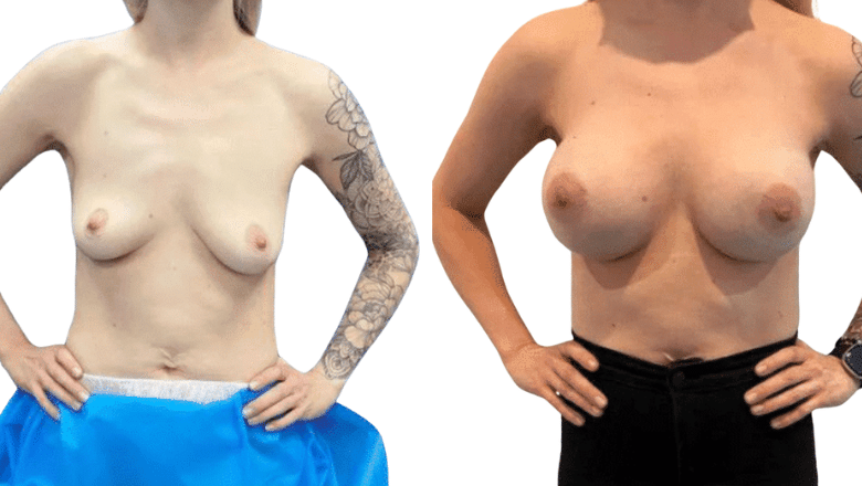breast surgery after results London