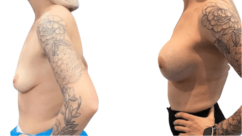 breast surgery before and after results London