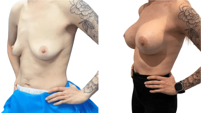 breast augmentation side profile before and after case 48 view 2