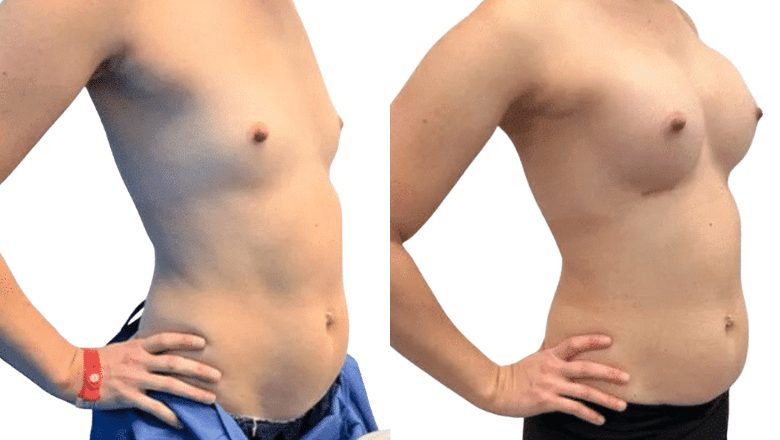 breast surgery UK before and after