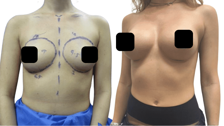 breast augmentation surgery London before and after case 49 view 2